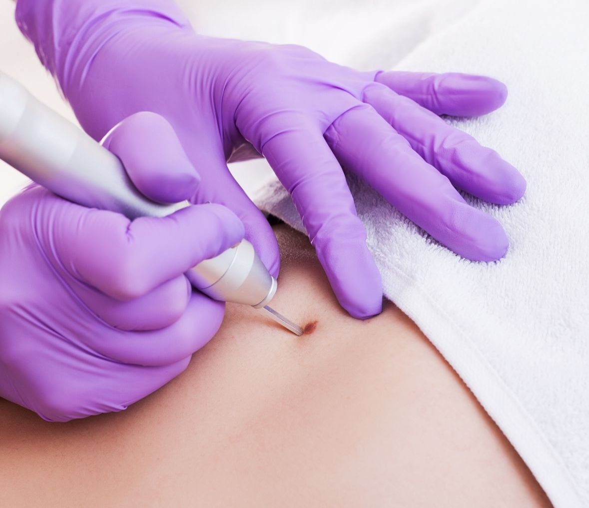 Excizii Formațiuni Cutanate - Procedură Chirurgicală