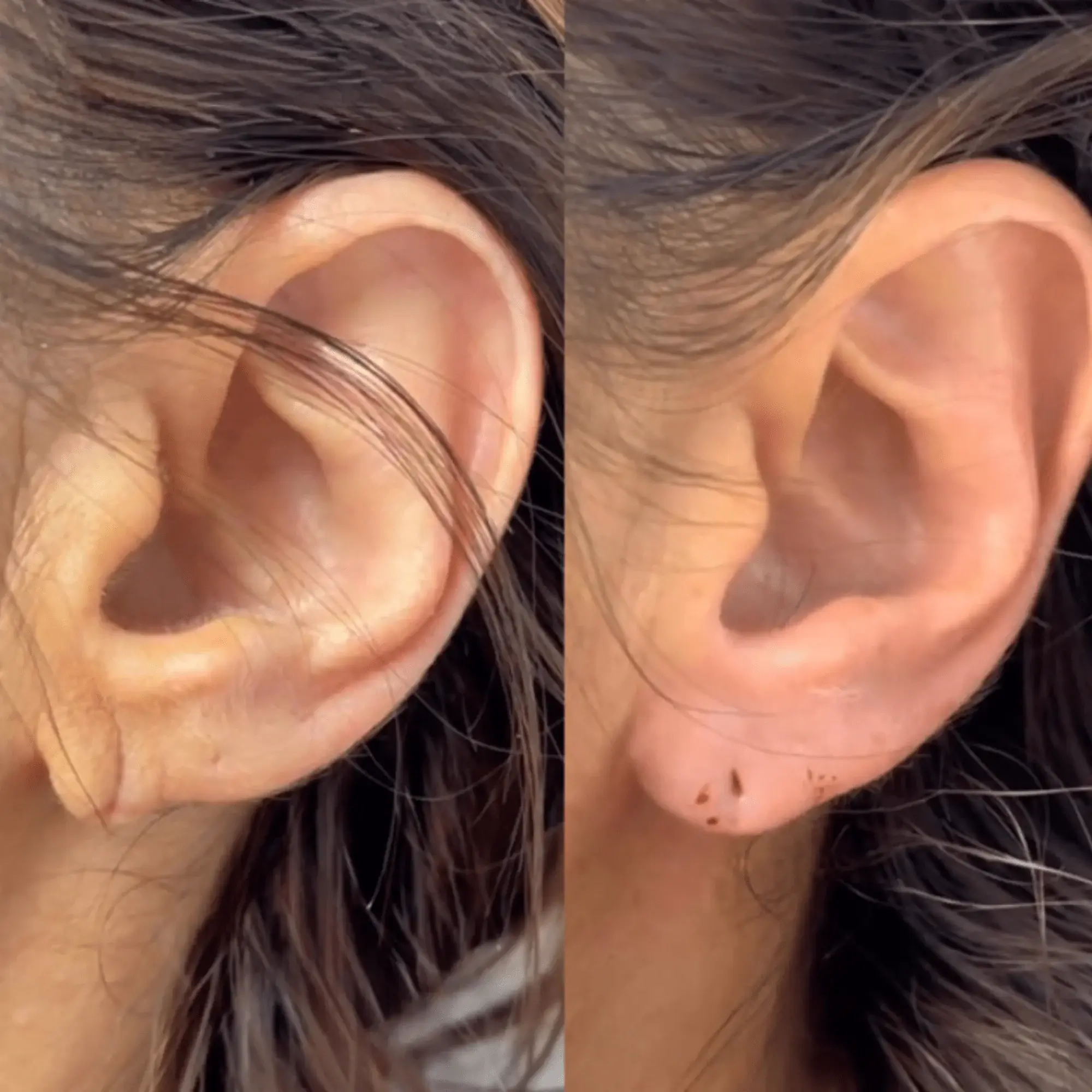 Reconstrucția Lobului Urechii