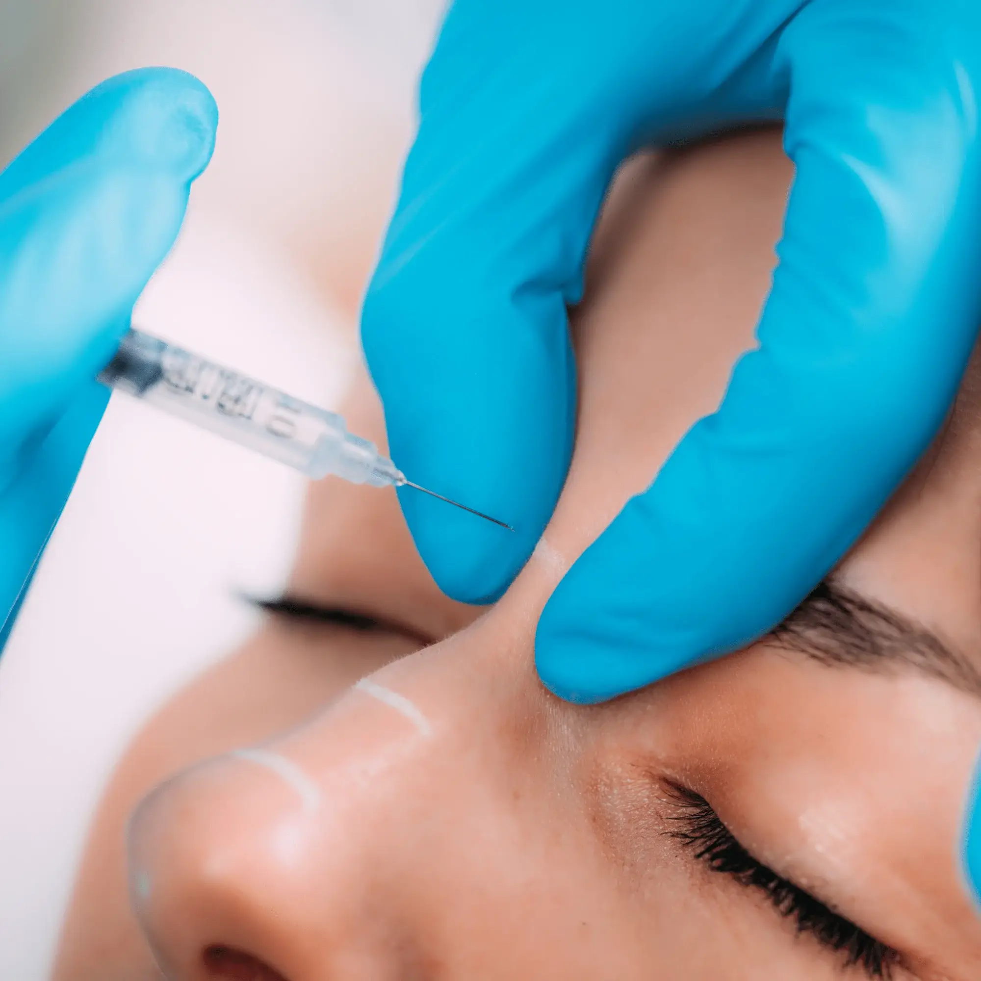 Rinoplastie Non-Chirurgicală