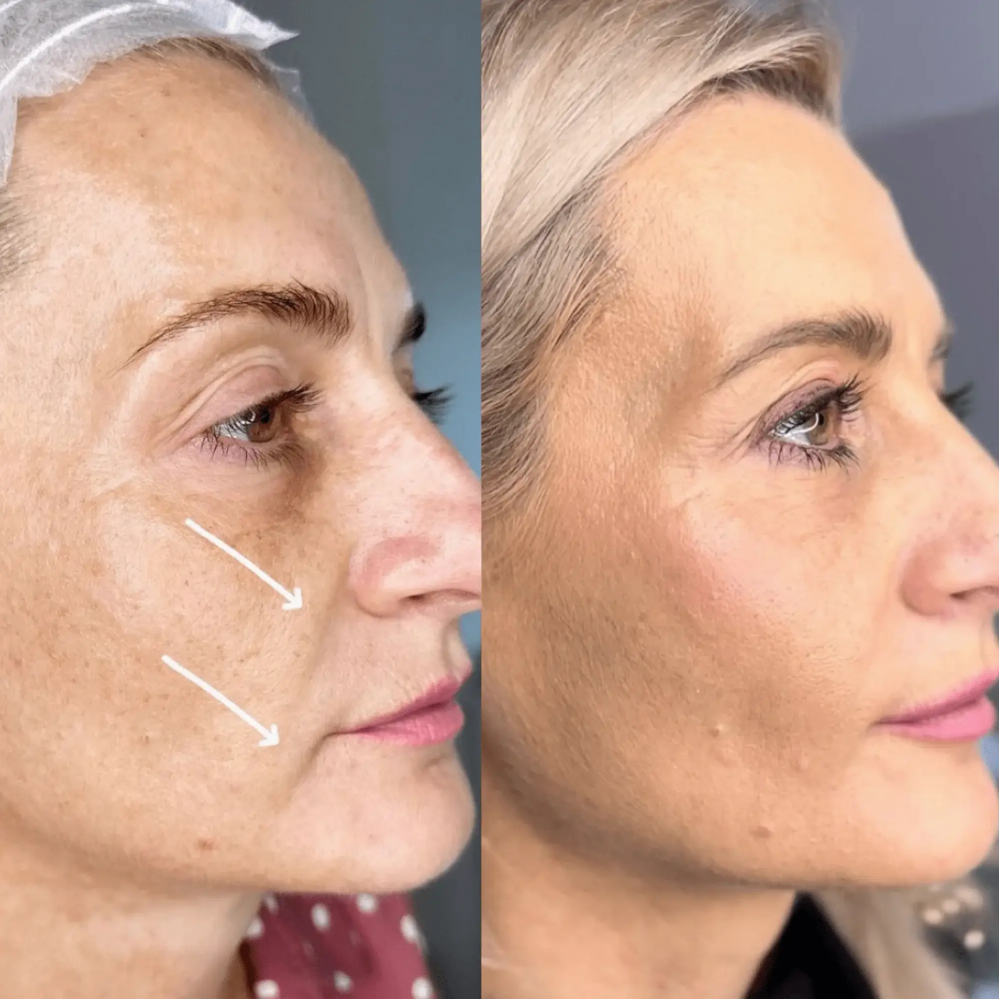 Sofwave - Lifting Non-Invaziv - Clinica Dr. Oana Manciu